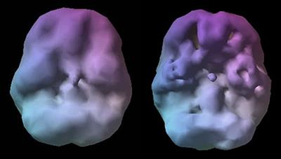 A New Way Forward: How Brain SPECT Imaging Can Improve Outcomes and Transform Mental Health Care Into Brain Health Care